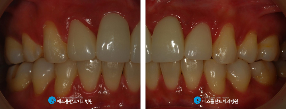 압구정로데오 앞니 벌어짐 정중이개 치료 잘하는 치과, 에스플란트치과병원의 전치부 심미보철 관련 이미지 6
