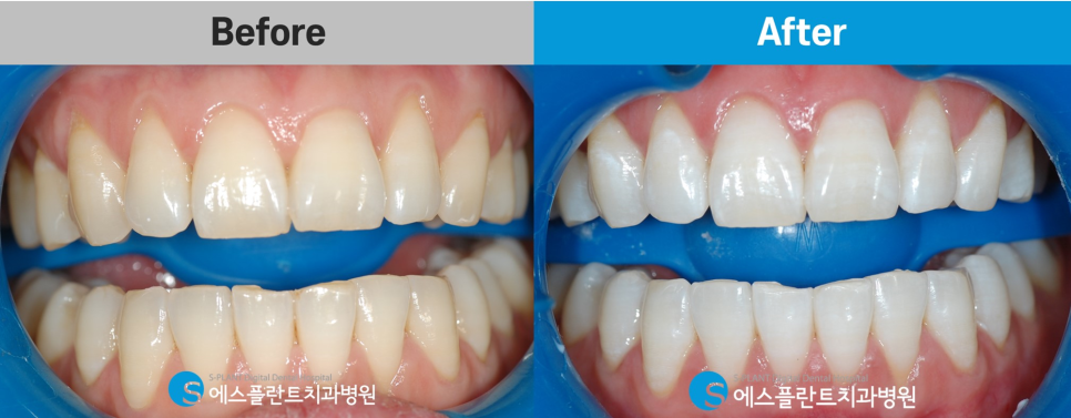 압구정로데오 치아미백 잘하는 치과, 에스플란트치과병원에서 착색된 치아를 하얗게 관련 이미지 5