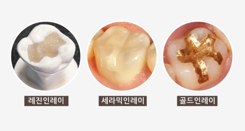 치아 크랙 치료, 균열 정도에 따라 달라집니다. [에스플란트 치과병원] 관련 이미지 3