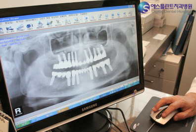 임플란트 &lsquo;3D시대&rsquo; 열렸다 관련 이미지 4