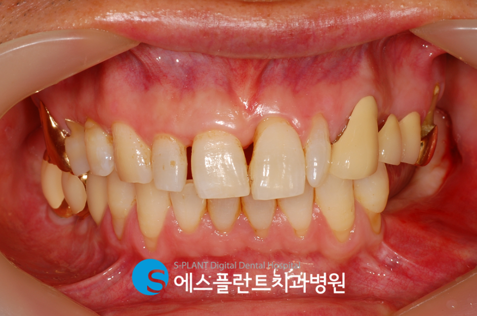 골이식을 동반한 고난이도 임플란트 시술 잘하는 치과, 에스플란트치과병원 관련 이미지 2