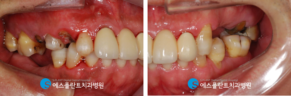 심한 충치로 인한 심미보철 및 임플란트 치료 잘하는 압구정로데오역 치과, 에스플란트치과병원 관련 이미지 3