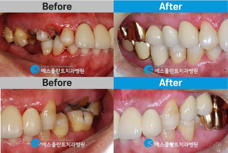 심한 충치로 인한 심미보철 및 임플란트 치료 잘하는 압구정로데오역 치과, 에스플란트치과병원 관련 이미지 8