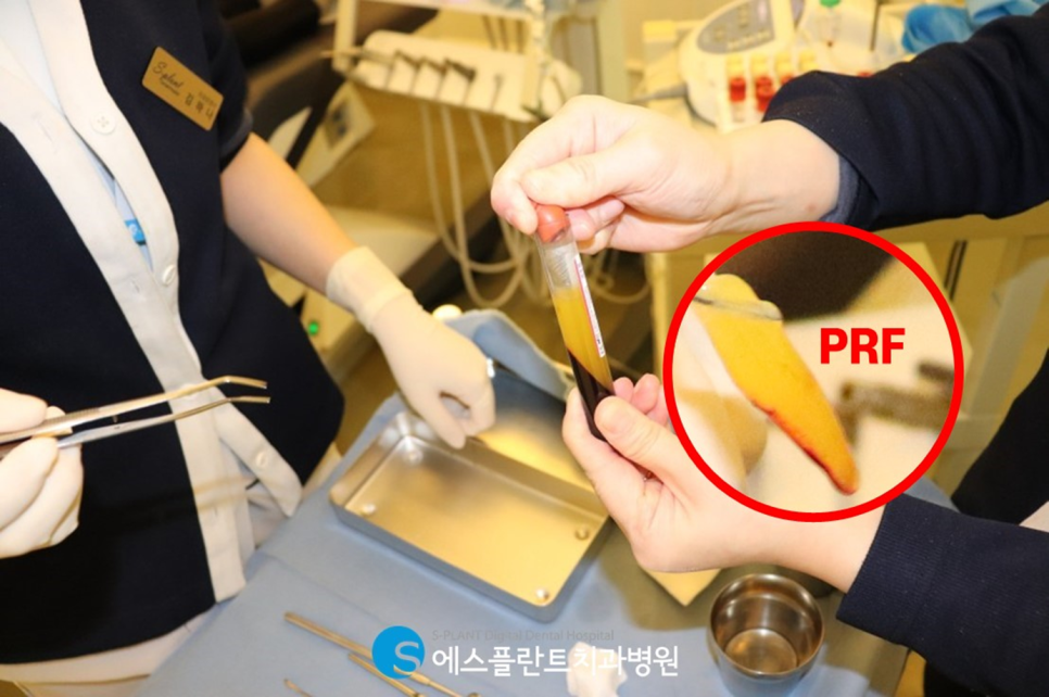 강남치과 에스플란트치과병원의 자가혈 임플란트(PRF)로 높은 성공률과 빠른 회복 관련 이미지 3
