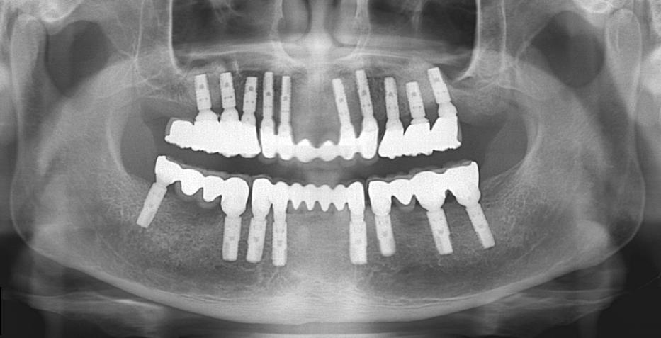 전체임플란트 핵심은 3D CT라고? 관련 이미지 3