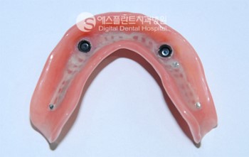 임플란트 틀니 잘하는 곳 "에스플란트치과병원" 관련 이미지 5