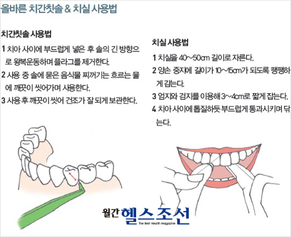 [임플란트주위염] 임플란트 심은 후 입내 심해졌다면?! 관련 이미지 4