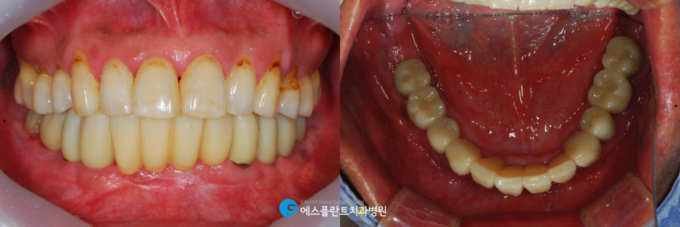 무치악으로 고민이라면?! 강남 무치악 임플란트 잘하는 치과, 에스플란트 치과병원에서 관련 이미지 5