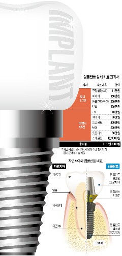 [임플란트가격]임플란트 병원따라 수백만원 차이&hellip;더 싼 곳? 더 비싼 곳? 아~ 고민되네 관련 이미지 1
