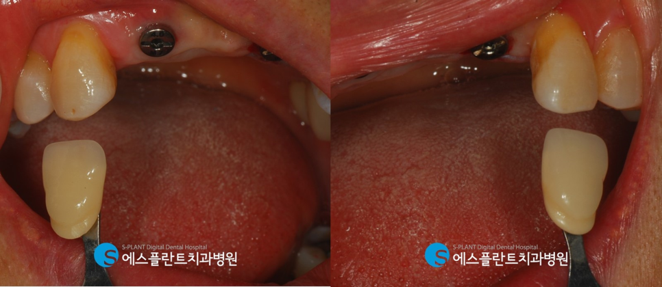 심한 골흡수가 있는 전치부 임플란트 잘하는 강남치과, 에스플란트치과병원 관련 이미지 6