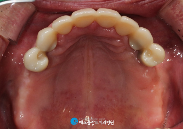 임플란트와 틀니의 장점만 모은 임플란트틀니 관련 이미지 8
