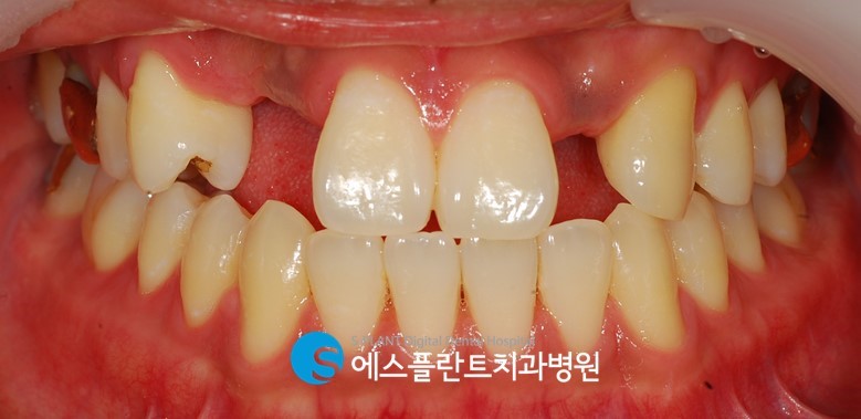 강남 임플란트 잇몸뼈 부족 시, 에스플란트 치과병원의 골이식 임플란트(GBR)로 관련 이미지 3
