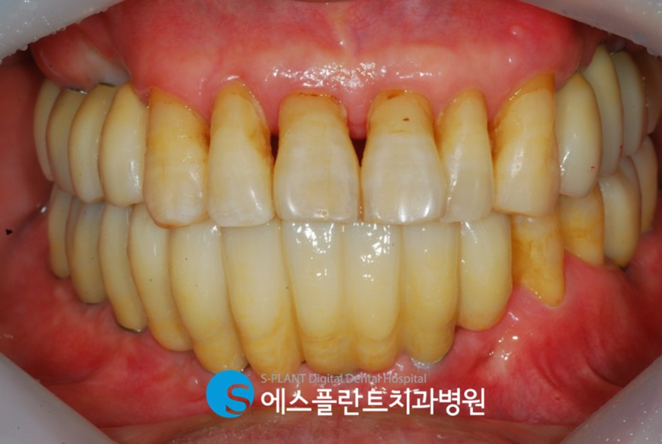임플란트 잘하는 치과, 에스플란트 치과병원의 임플란트 모의수술과 가이드 제작으로 안전하게 관련 이미지 9