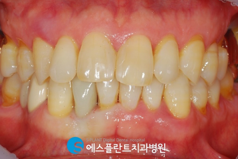 바쁜 현대인을 위한 즉시기능임플란트! 관련 이미지 6