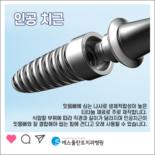 임플란트 재수술도 실력이 검증된 에스플란트 치과병원에서 관련 이미지 5