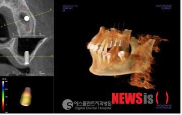 [에스플란트치과병원] "임플란트, CT 정밀검진으로 꼭 필요한 뼈이식만 하세요" 관련 이미지 1
