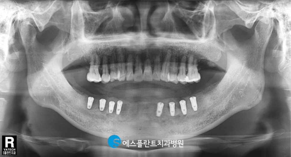 하악 무치악 임플란트 수술 고민이라면?! 청담 임플란트 잘하는 치과 에스플란트 치과병원에서 관련 이미지 5