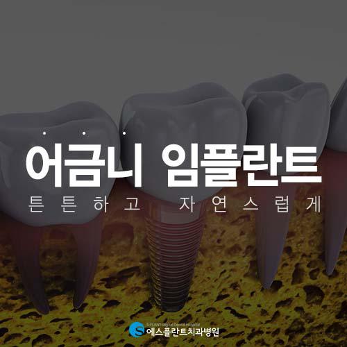 튼튼함이중요한어금니임플란트 관련 이미지 1