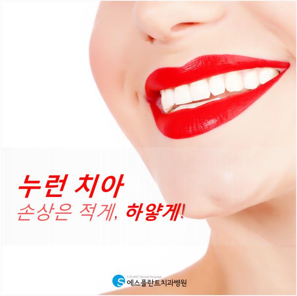 누런치아,손상줄이고하얗게만드는방법 관련 이미지 1