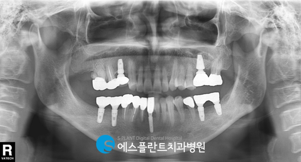 하악 대구치 임플란트 시 가이드 임플란트가 필요한 이유?! 하치조 신경 손상 피해 에스플란트 치과병원에서 정확하고 안전하게 관련 이미지 7