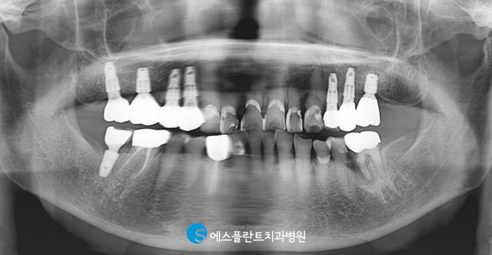 Gangnam Apgujeong Rodeo Dental Clinic: A Dental Clinic Skilled in Immediate Implant Placement After Extraction of a Loose Molar, S-Plant Dental Hospital image 2