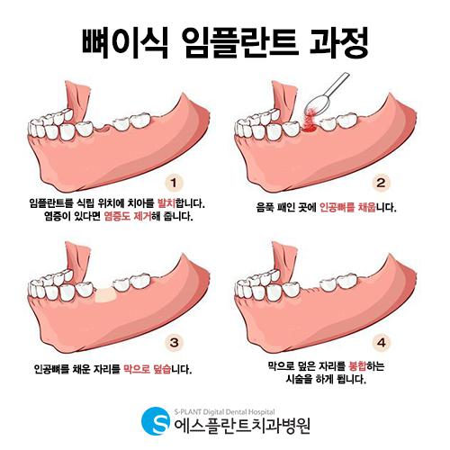 뼈이식임플란트 성공적인 임플란트의 지름길 – 에스플란트치과병원 관련 이미지 5