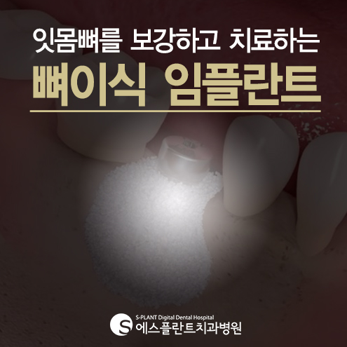뼈이식임플란트 성공적인 임플란트의 지름길 – 에스플란트치과병원 관련 이미지 1