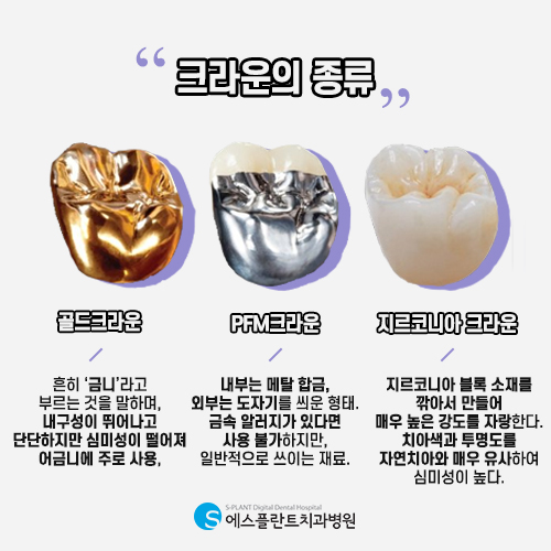 맛있는 음식을 편하게 먹기위해 에스플란트의 어금니 임플란트 관련 이미지 5