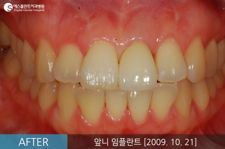 [뼈이식임플란트] 앞니 임플란트, 뼈이식 앞니 임플란트 전후 CASE 관련 이미지 3