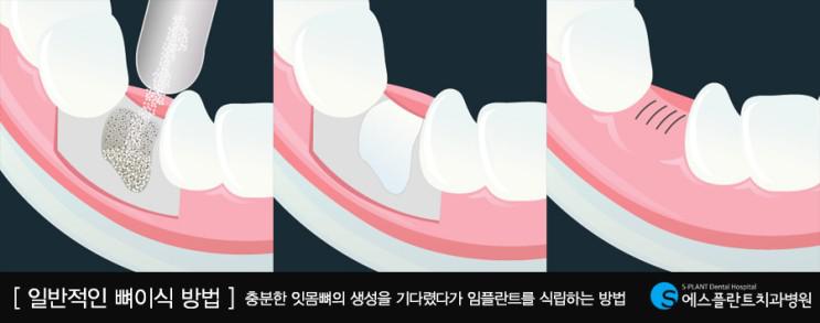 임플란트뼈이식을해야하는데,뼈이식통증이걱정되시나요? 관련 이미지 3