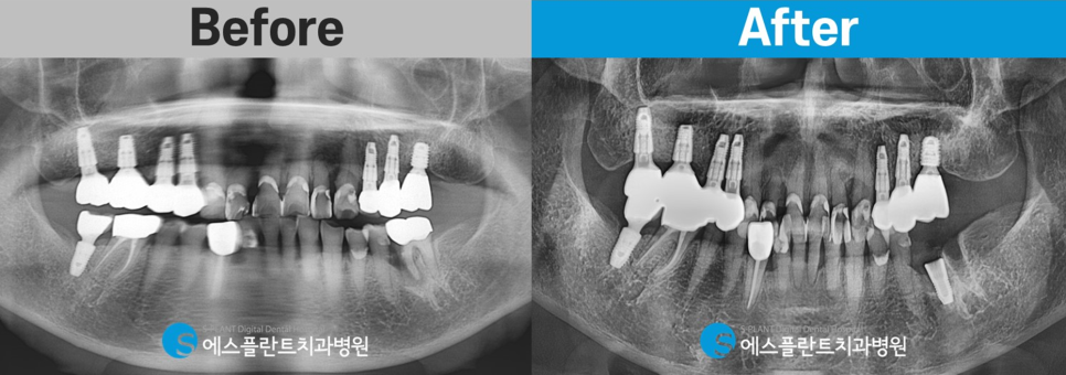 Gangnam Apgujeong Rodeo Dental Clinic: A Dental Clinic Skilled in Immediate Implant Placement After Extraction of a Loose Molar, S-Plant Dental Hospital image 6