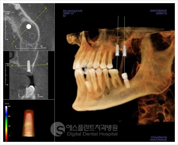 노인임플란트선택,안전성꼼꼼히체크하는것이중요 관련 이미지 3