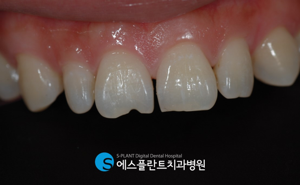 앞니 깨짐으로 인한 심미보철을 원한다면 - 강남 심미보철 잘하는 치과 에스플란트치과병원에서 관련 이미지 2