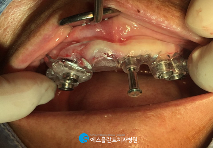 치아를 즉시 사용해야 한다면? 에스플란트치과에서 즉시기능임플란트 하세요! 관련 이미지 5