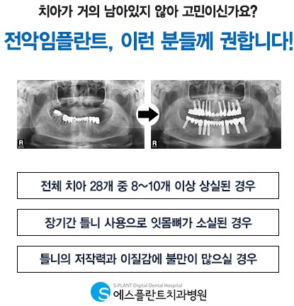 전악임플란트, 새로운 삶 얻어. – 에스플란트치과병원 관련 이미지 4