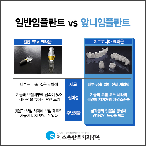 심미성이 중요한 앞니 임플란트도 믿을 수 있는 에스플란트 치과병원에서 관련 이미지 5