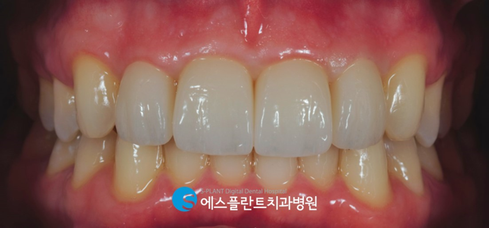 압구정치과 전치부 심미보철 수복 잘하는 에스플란트치과병원 관련 이미지 6