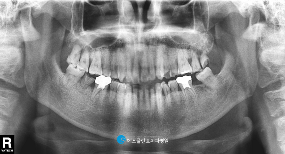 앞니 임플란트 잘하는 강남 에스플란트치과병원에서 내 치아처럼! (feat. 지르코니아 심미 임플란트 보철물) 관련 이미지 2