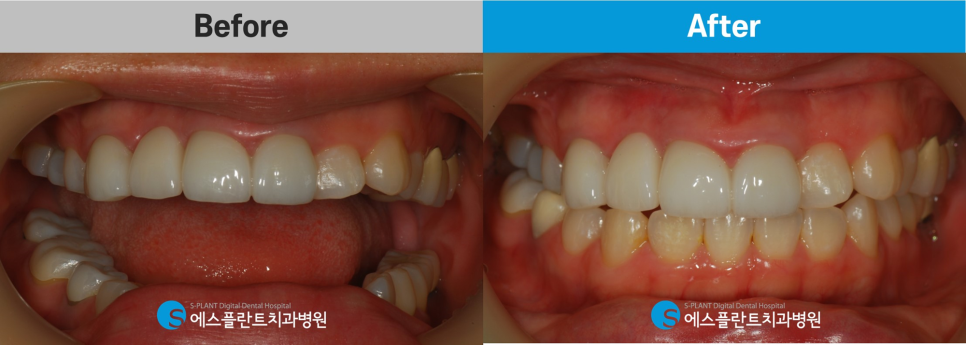 강남 잇몸치료, 치은절제술(gingivectomy)이 가능한 치과를 찾고 있다면?! 관련 이미지 5
