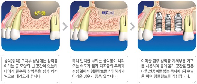 [뼈이식 임플란트 시술과정] 상악동거상술, 뼈이식 임플란트의 중요성 관련 이미지 3