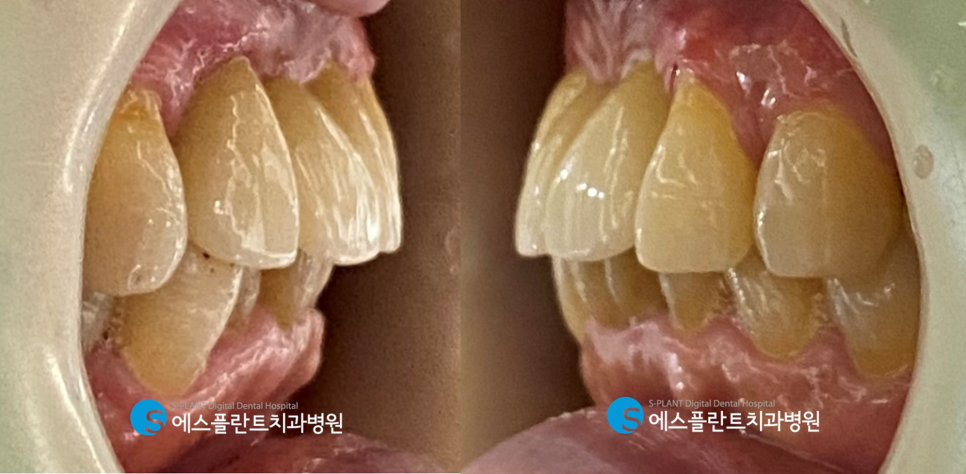 심한 골흡수가 있는 전치부 임플란트 잘하는 강남치과, 에스플란트치과병원 관련 이미지 8