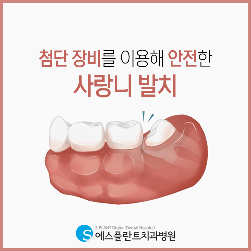 압구정 치과, 에스플란트의 사랑니 발치와 주의사항 관련 이미지 3