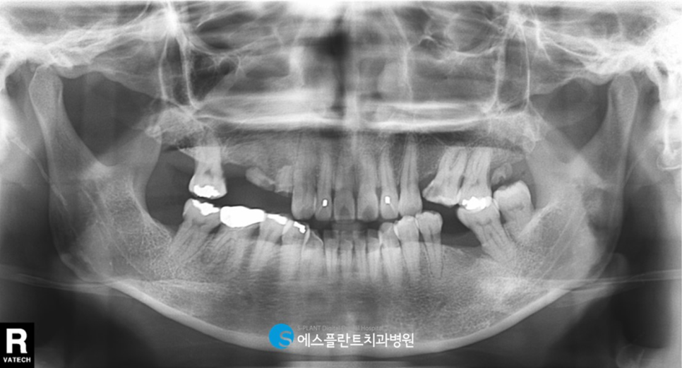 강남치과 에스플란트치과병원의 가이드 임플란트로 만족도 높게! 관련 이미지 2