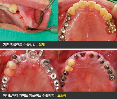 임플란트 치과, 강남 임플란트 잘하는 치과 에스플란트치과병원 관련 이미지 9