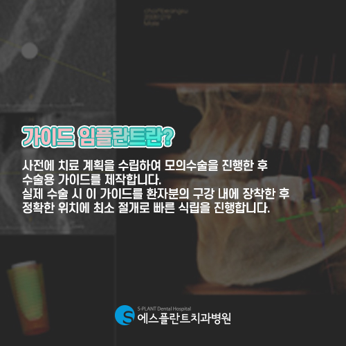 오차없는 임플란트 식립, 에스플란트의 가이드 임플란트 관련 이미지 4