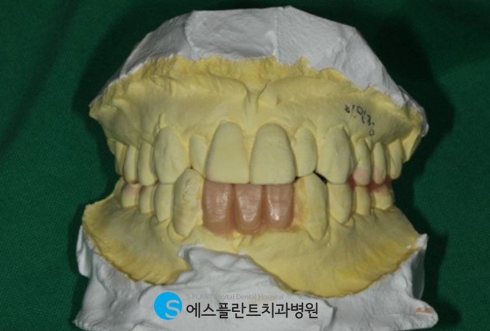 뻐 폭이 좁은 아래 앞니 임플란트 잘하는 치과, 강남 에스플란트치과병원 관련 이미지 5