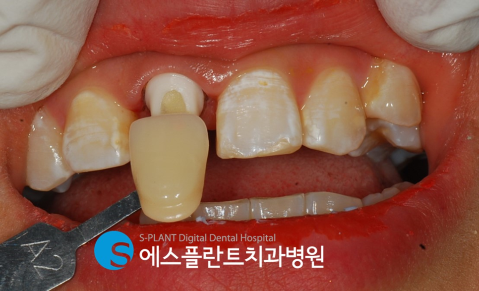 강남 부러진 앞니 임플란트 잘하는 치과, 에스플란트치과병원(전치부 발치 즉시 임플란트 및 당일 임시치아 세팅) 관련 이미지 5