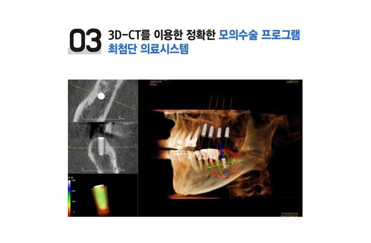 당뇨환자임플란트 시술 가능할까요? 에스플란트치과병원 관련 이미지 4
