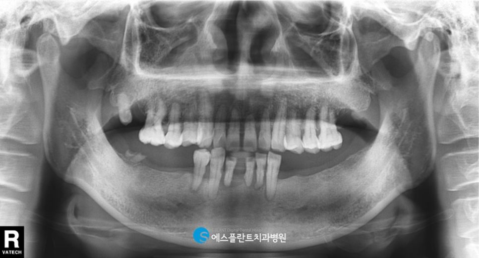 무치악으로 고민이라면?! 강남 무치악 임플란트 잘하는 치과, 에스플란트 치과병원에서 관련 이미지 1