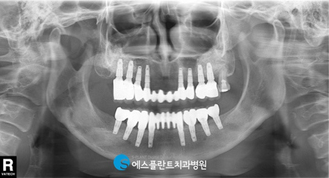 전악임플란트로 치아 기능을 회복하세요! <전악임플란트 치료사례> 관련 이미지 5